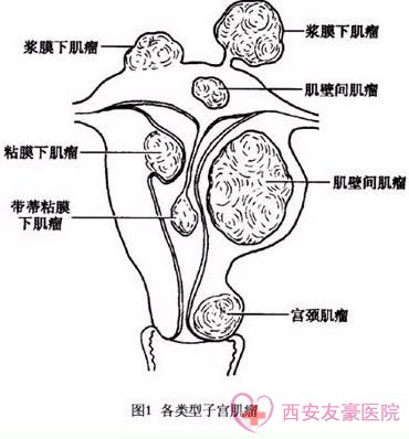 远离宫颈肥大的方法